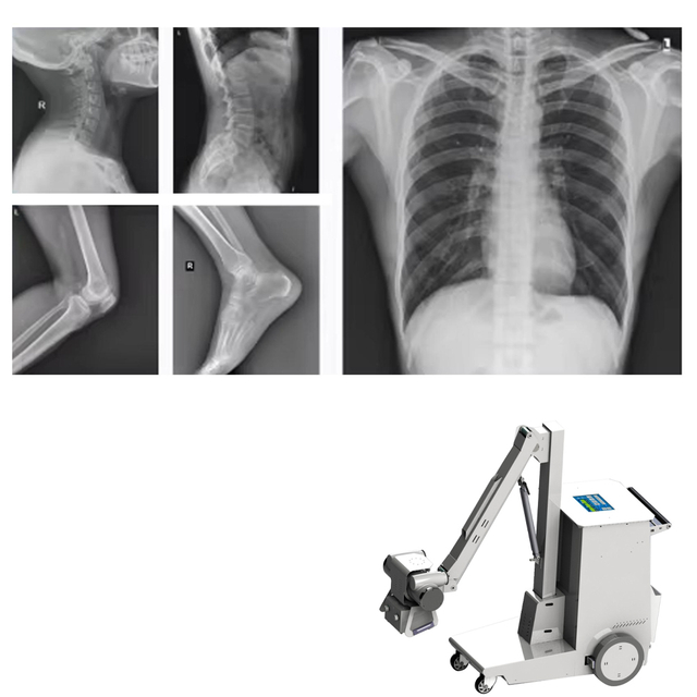 Medical Mobile Digital X Ray Machine Portable Xray Machine Medical X-ray 8kw Fluoroscopy X-ray Machine
