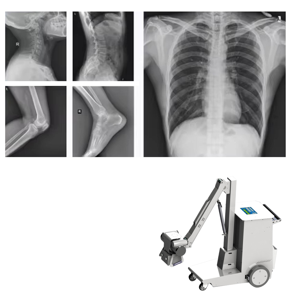 Medical Mobile Digital X Ray Machine Portable Xray Machine Medical X-ray 8kw Fluoroscopy X-ray Machine