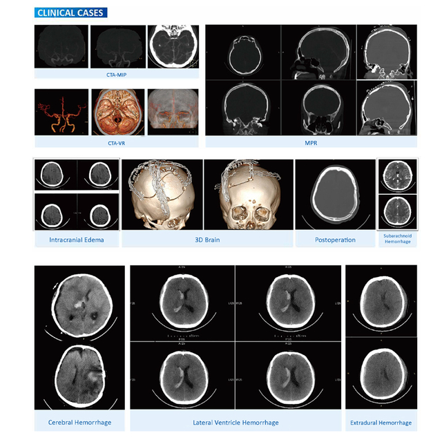 Mobile Medical Rapid Diagnosis CT Radiology CT Scanner Metal Computed Tomography Scanning Machine