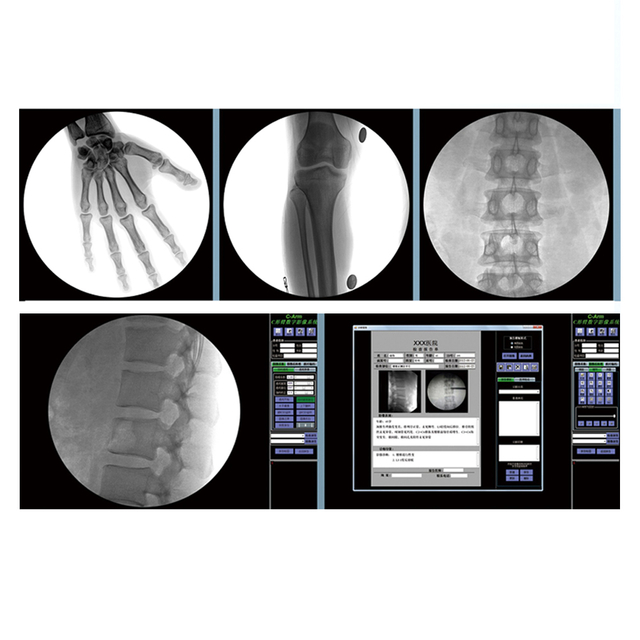5KW High Frequency Mobile C Arm Digital Surgical X-ray C-Arm System with FP Detector Electric Power Source and Metal Material